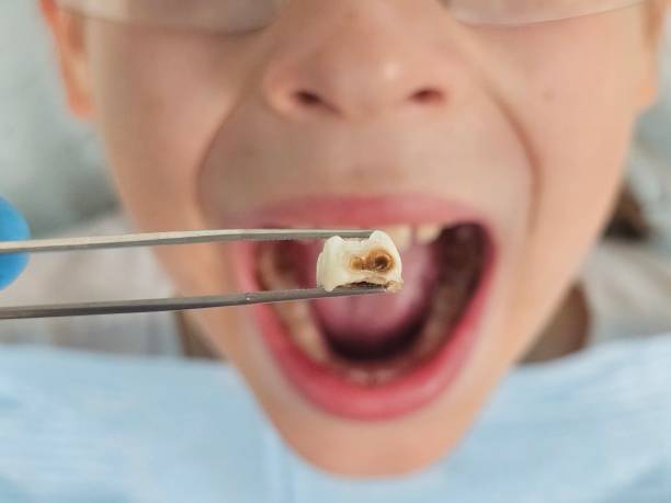 Best Emergency Dental Extractions in Battlement Mesa, CO